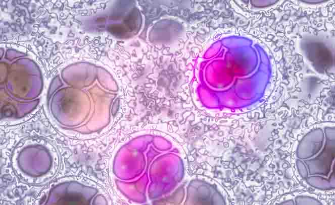 Leucemia linfatica cronica