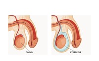 Idrocele