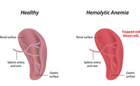 Anemia emolitica