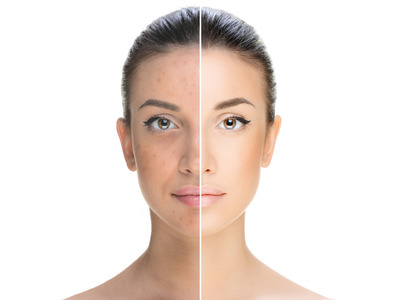Consulenza acne - Laura Breseghello | Pazienti.it