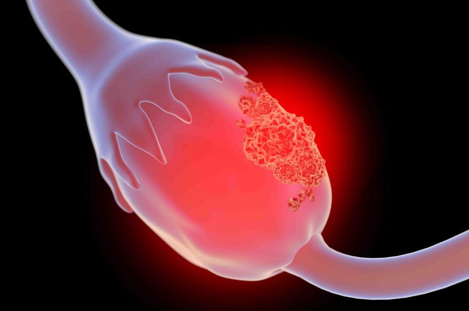 Talco e tumore alle ovaie: nessun legame pericoloso