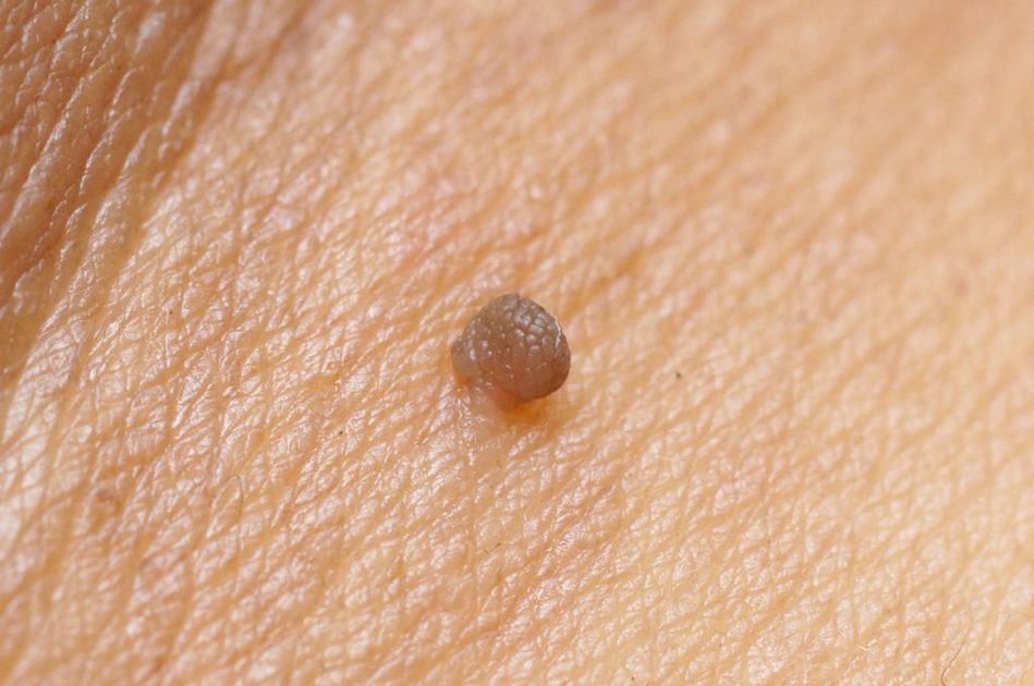 Come eliminare un Fibroma pendulo