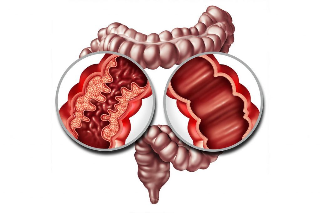 Intestino e malattia di Crohn