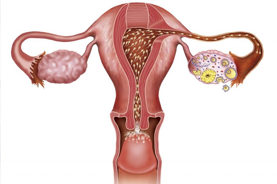 Piaghetta all'utero: come si forma e come si cura