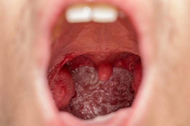 Cosa mangiare con il mal di gola: la dieta per alleviare i sintomi