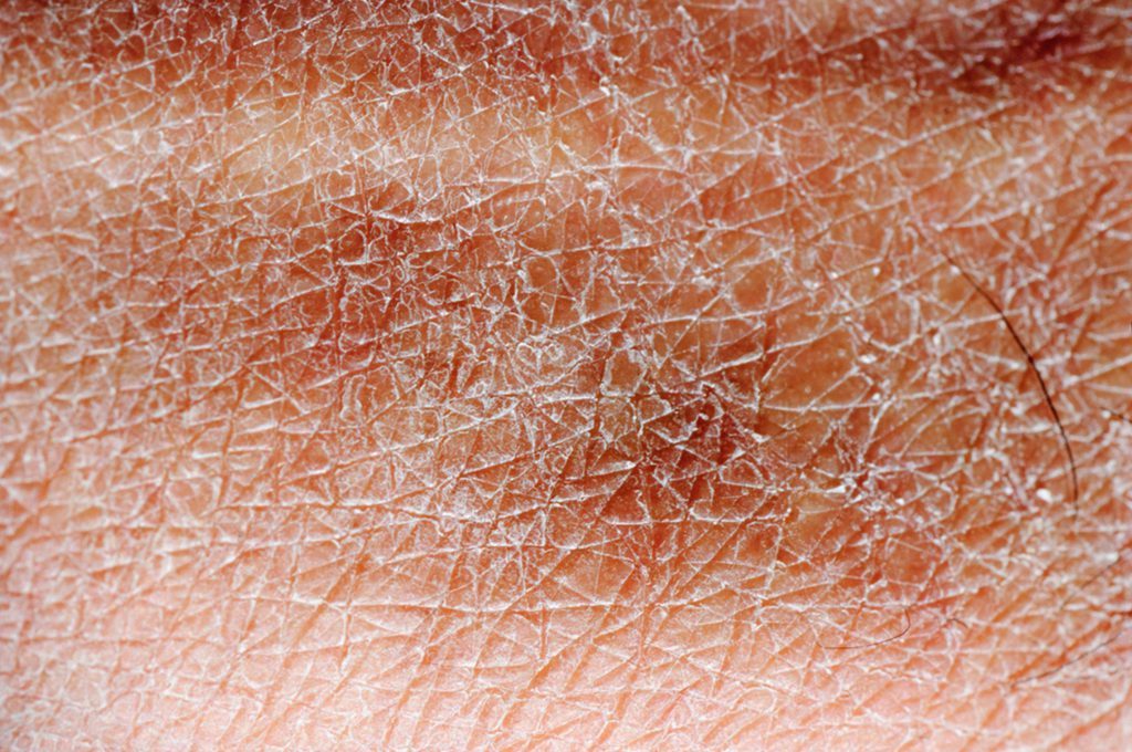 Pelle secca in menopausa? Qualcosa si può fare per evitarla Pazienti.it Pelle secca in menopausa? Qualcosa si può fare per evitarla Pazienti.it