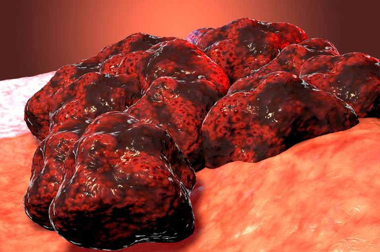 Mammografia per uomini Mammografia per uomini, per una diagnosi precoce di tumore al seno
