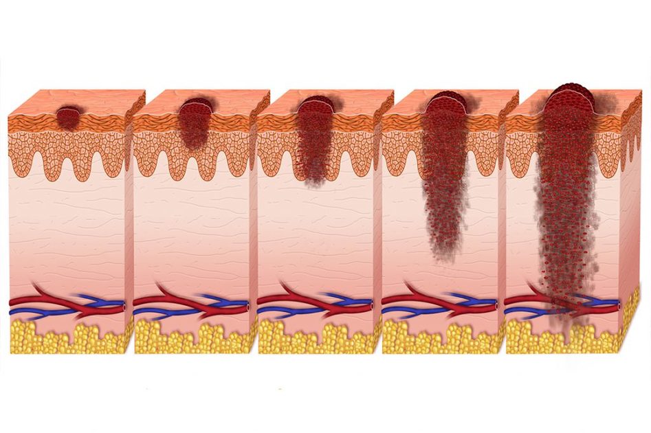 Melanoma Acrale Lentigginoso