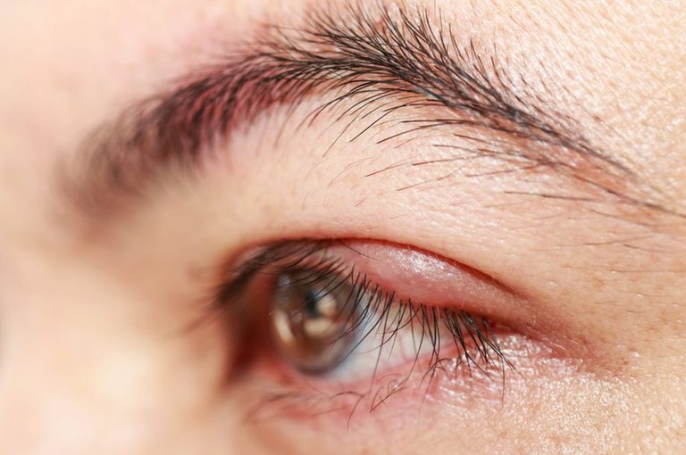 Rimedi naturali orzaiolo