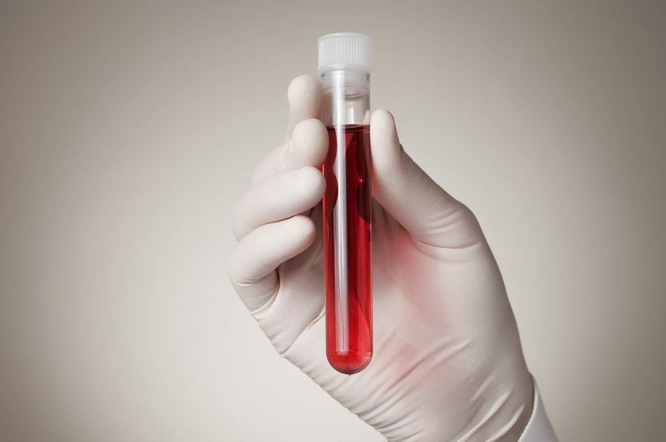 Esame del sangue per determinare il rischio di morte