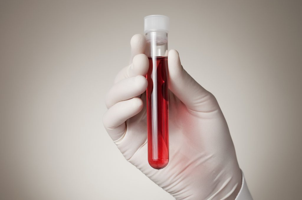 Esame del sangue per determinare il rischio di morte