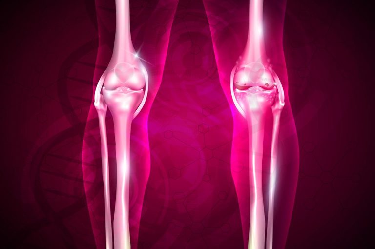 Artrosi: mette a rischio il nostro cuore