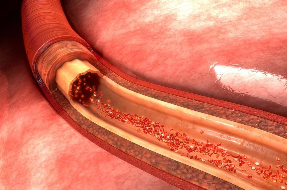 Acido Urico e Fruttosio: il Legame