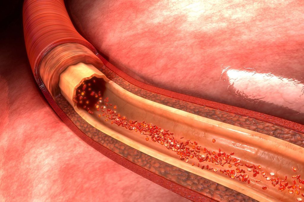 Acido Urico e Fruttosio: il Legame