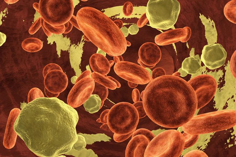 Colesterolo cattivo basso aumenta il rischio di ictus emorragico