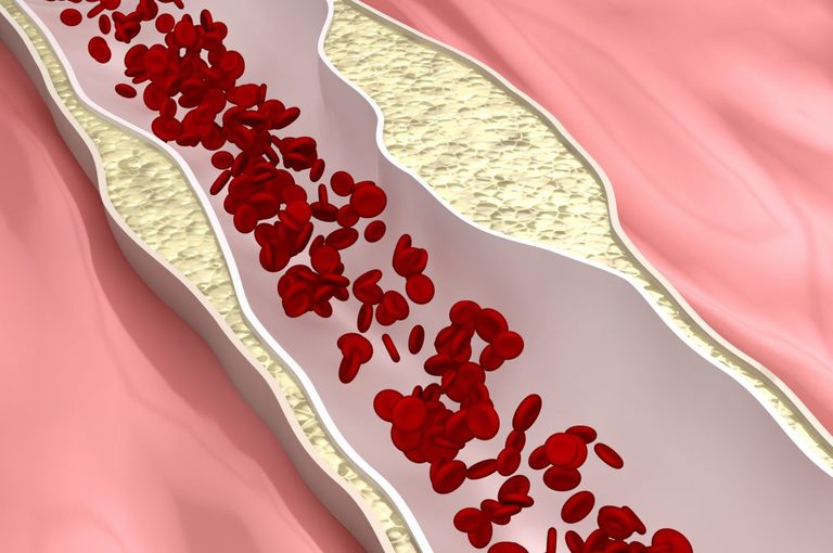 Aterosclerosi: individuato l'ozono come fattore di rischio