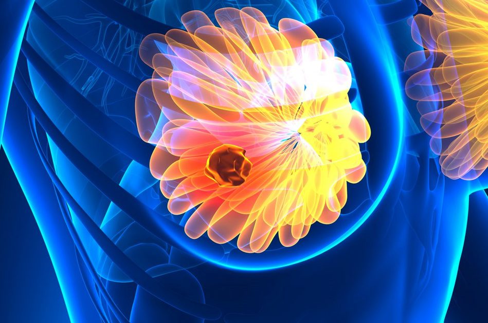 Talazoparib per il Trattamento del Tumore al seno