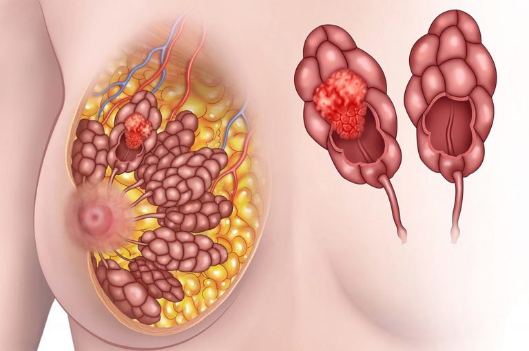 Mammografia 3d in Tomosintesi