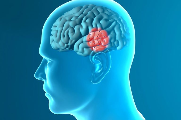 Primi sintomi di Parkinson