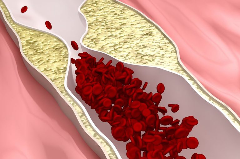 colesterolo e alzheimer: il legame