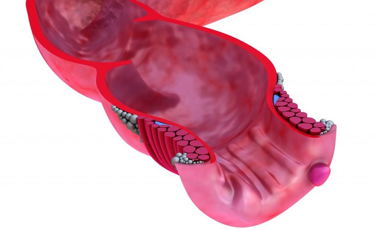 Emorroidi: i Trattamenti