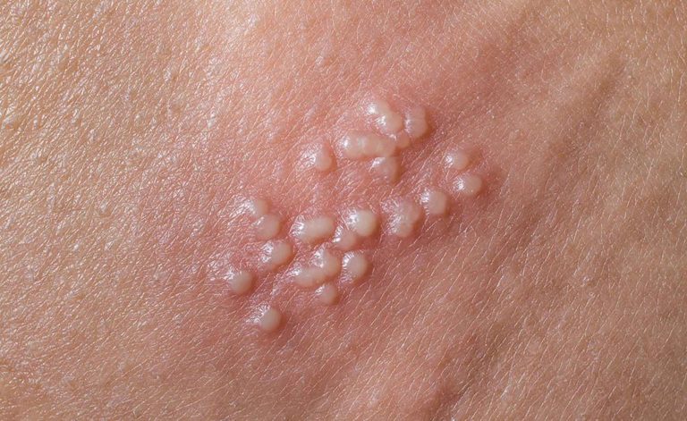 Le malattie esantematiche in età adulta: i pericoli