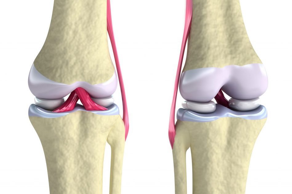Come accorgersi del Menisco Rotto?