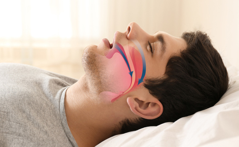 apnee: cause e rischio demenza