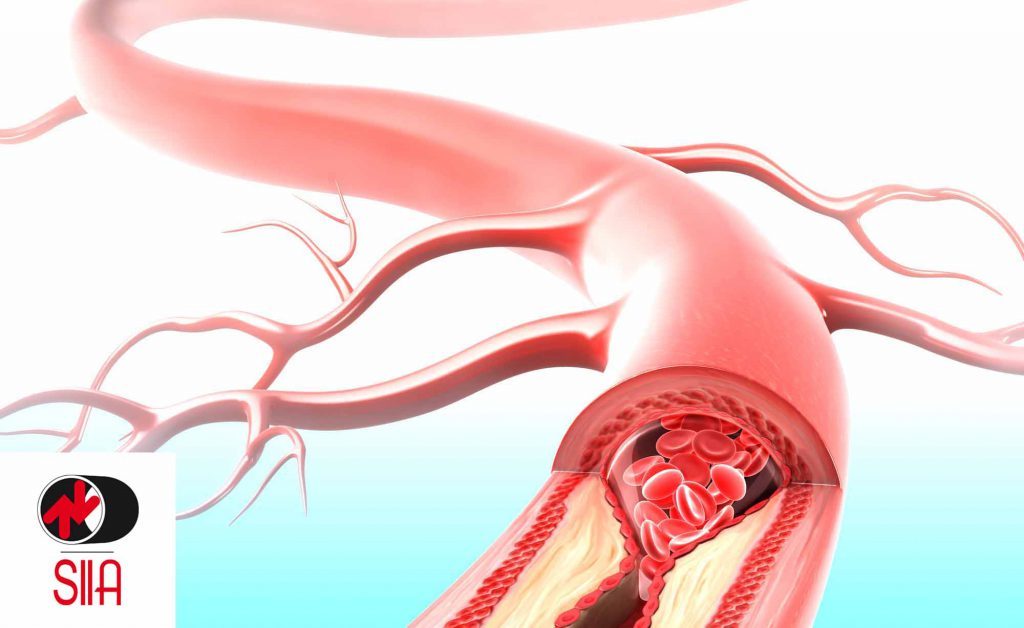 Ictus cause e fattori di rischio