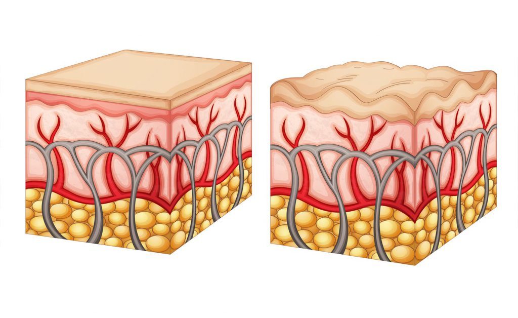 Cellulite: come Trattarla