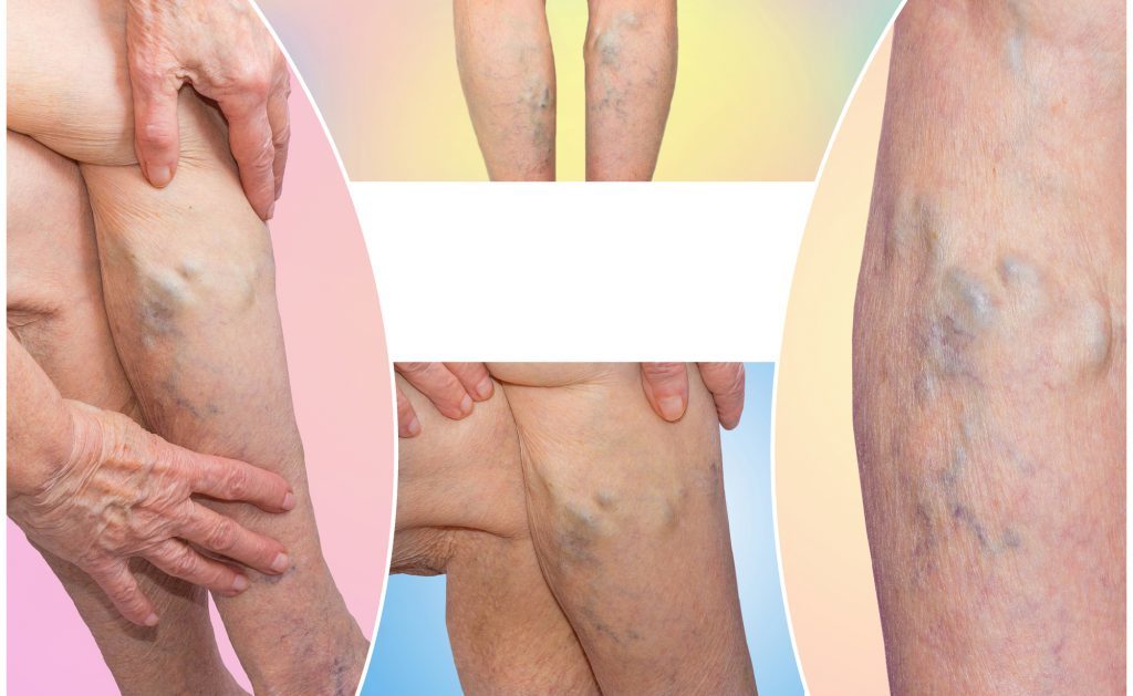 Vene varicose: cosa fare