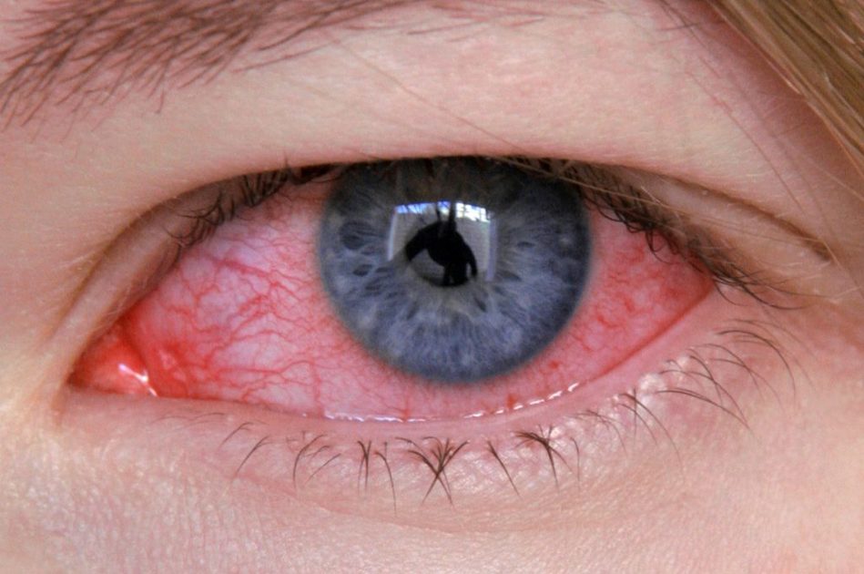 Tutto sulle allergie oculari