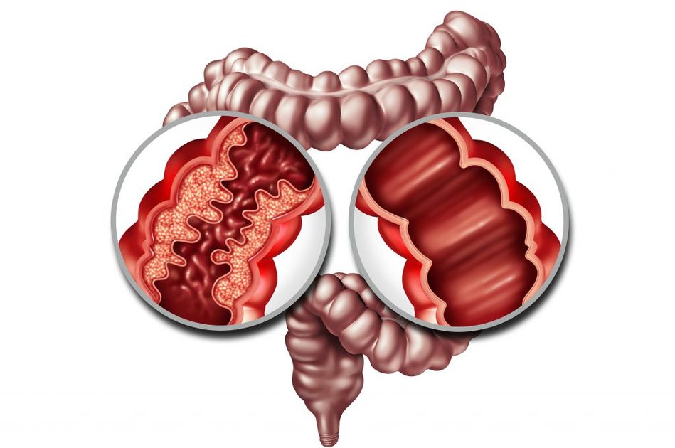 Calprotectina alta o bassa: come interpretare i valori