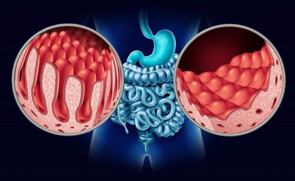 Celiachia: sintomi e cause