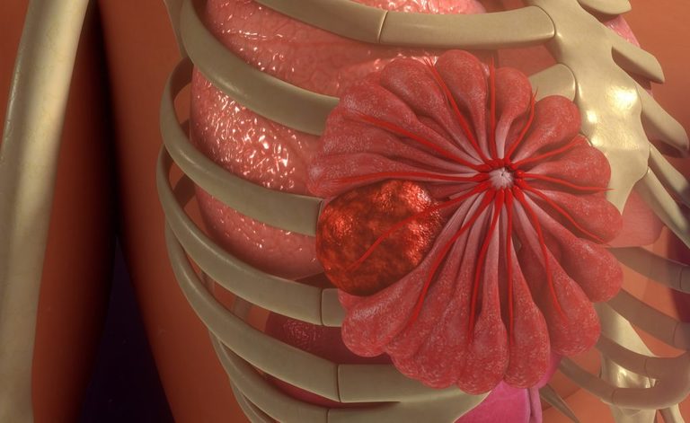Tumore al seno e vitamina D: gli effetti positivi