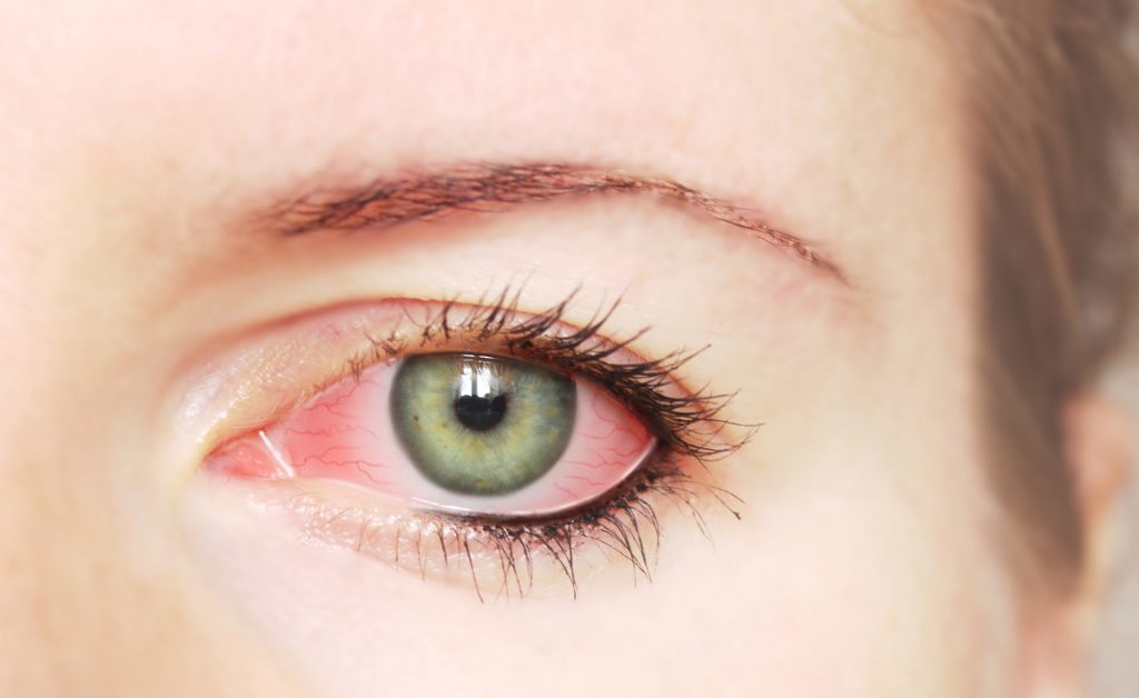 Le macchie occhi rossi