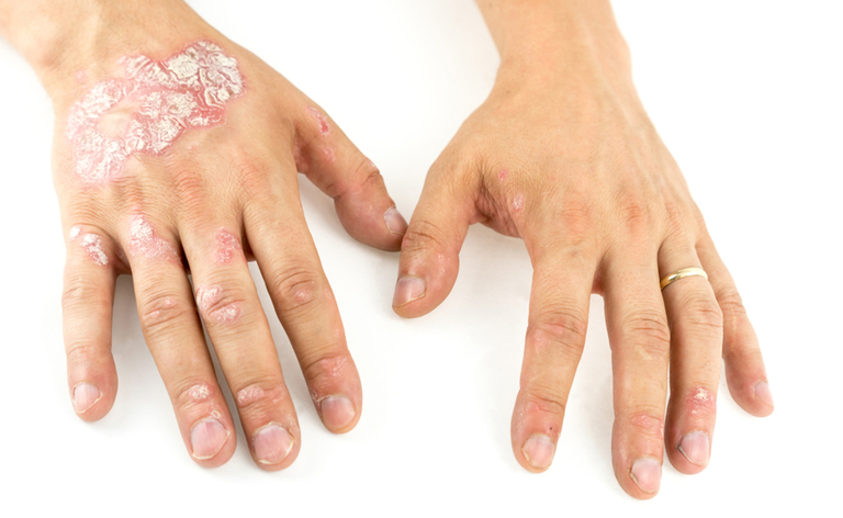 Psoriasi e malattie cardiache Psoriasi e malattie cardiache: il legame