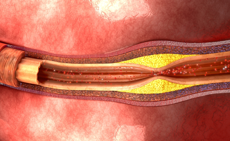 Alirocumab, per la riduzione del rischio cardiovascolare