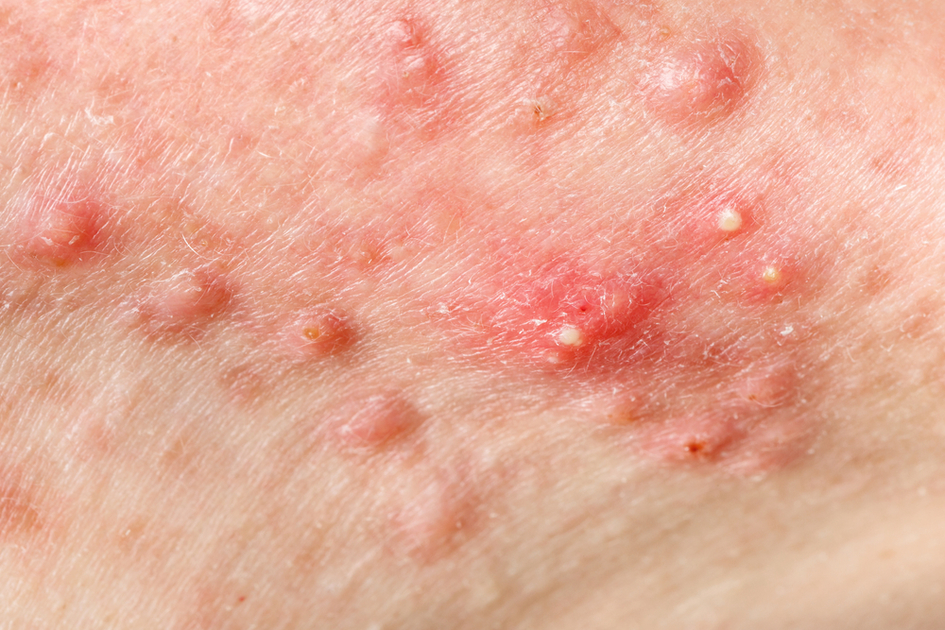 Rimedi naturali per l'acne cistica: quali sono?