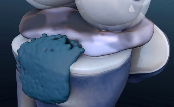 encondroma: sintomi e cure