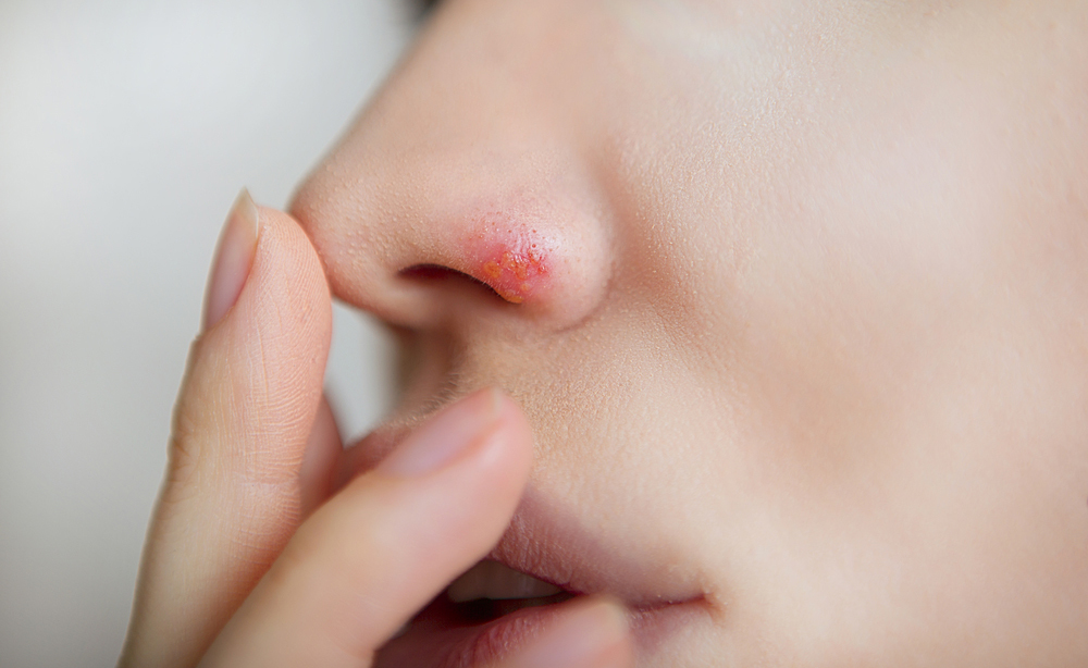 Come curare l'Herpes al naso