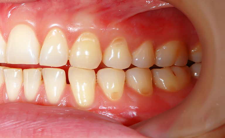 Cosa fare per le gengive sanguinanti?