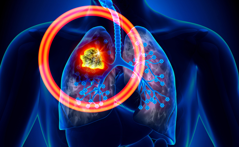 Tumori più diffusi nel 2019