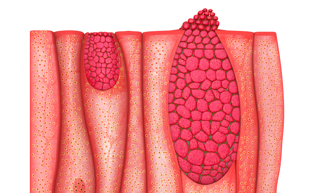 epitelioma basocellulare