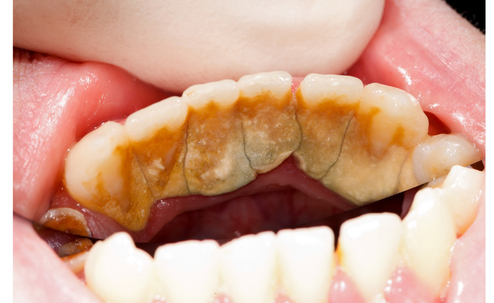 Come togliere il tartaro dai denti