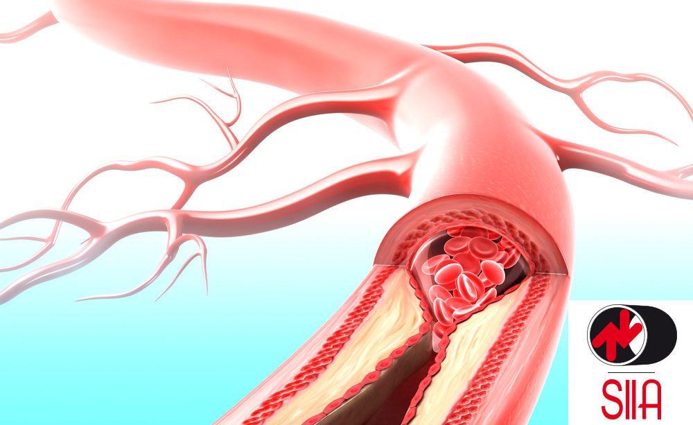 Diabete e Ictus: il Legame