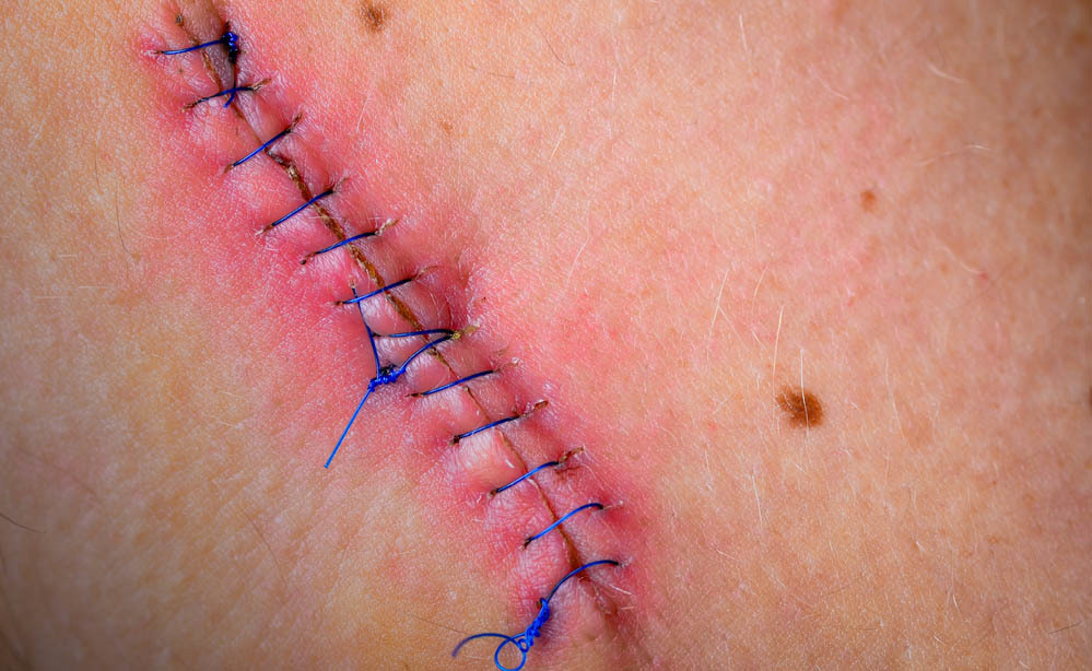 Cicatrice e come Trattarla