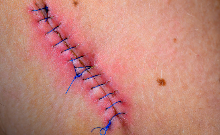 Cicatrice e come Trattarla
