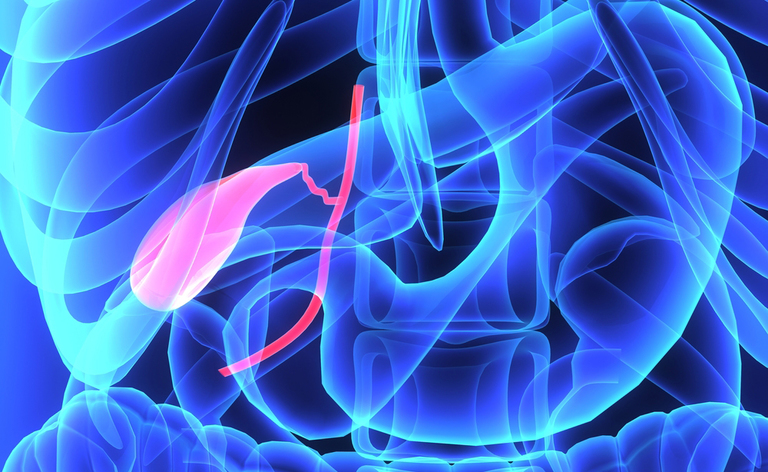 calcoli alla colecisti: quando vanno operati?