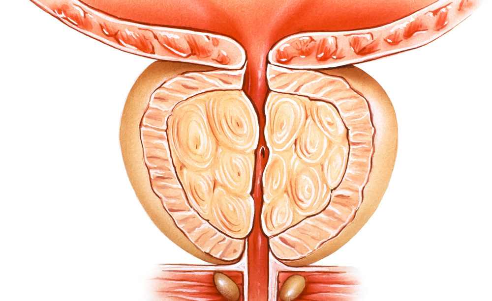 Ipertrofia Prostatica: gli Esercizi contro l'Incontinenza